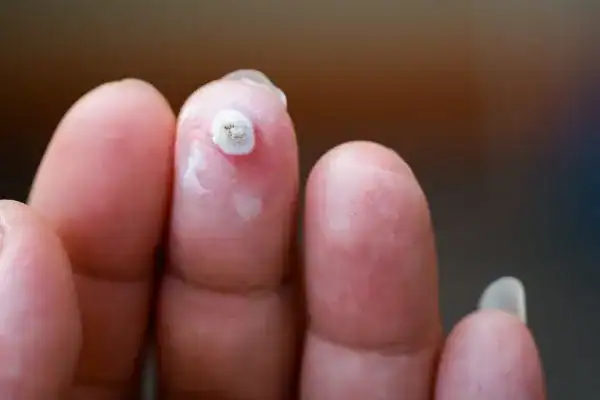 Image of white wart before cryopen treatment Weymouth