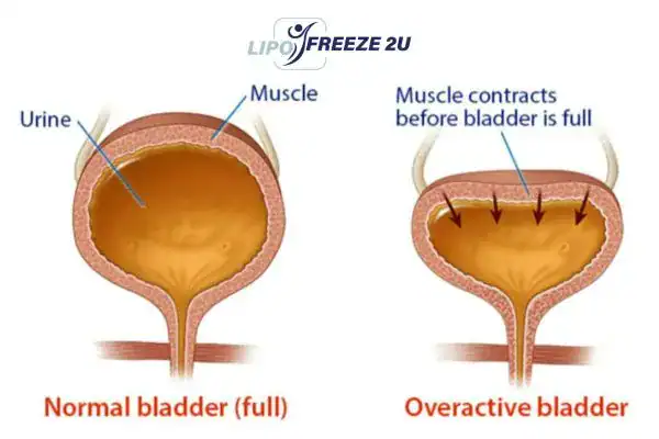 diagram of overactive bladder treatment Weymouth
