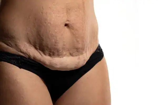 loose skin after weight loss injections Weymouth