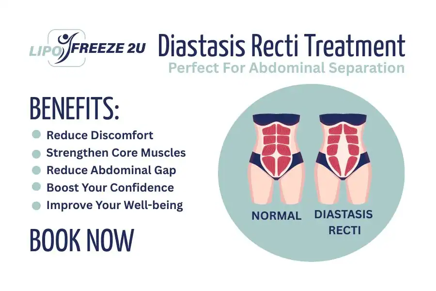 Benefits of body toning treatment Weymouth for Diastasis recti