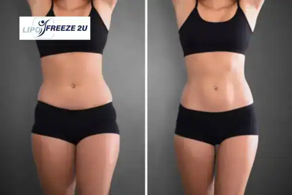 How Can LIPO FREEZE 2U Support Your Post-Pregnancy Body Recovery Weymouth?