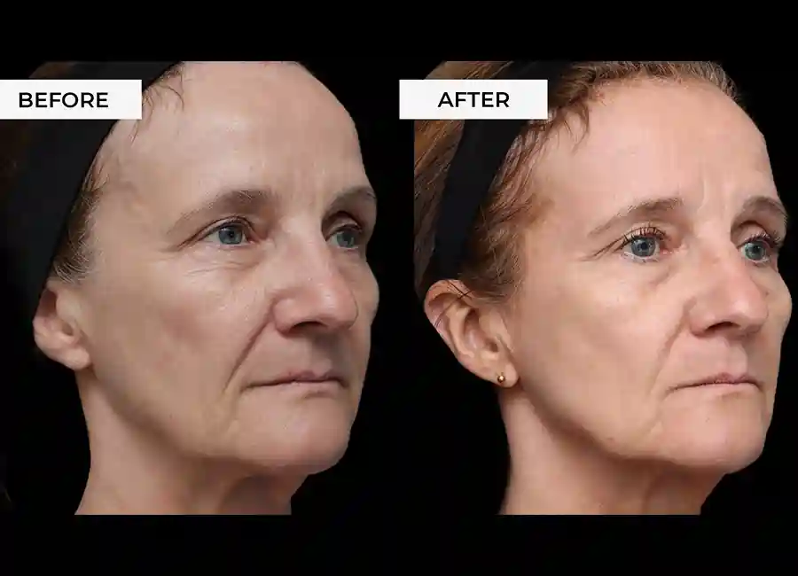 How Many RF Microneedling Sessions Will You Need to See a Difference Weymouth?