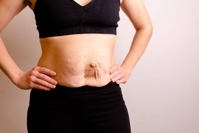 Is Surgery Really the Only Way to Repair Diastasis Recti Weymouth?