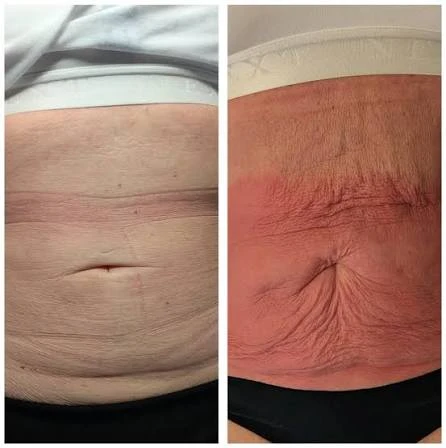 How Does RF Microneedling Improve Crepey, Thin and Uneven Skin Texture Weymouth?