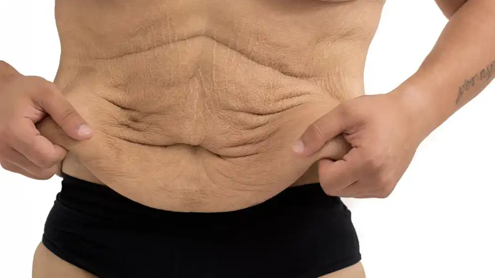 Why Does Weight Loss Medication Leave Some People With Loose or Sagging Skin Weymouth?